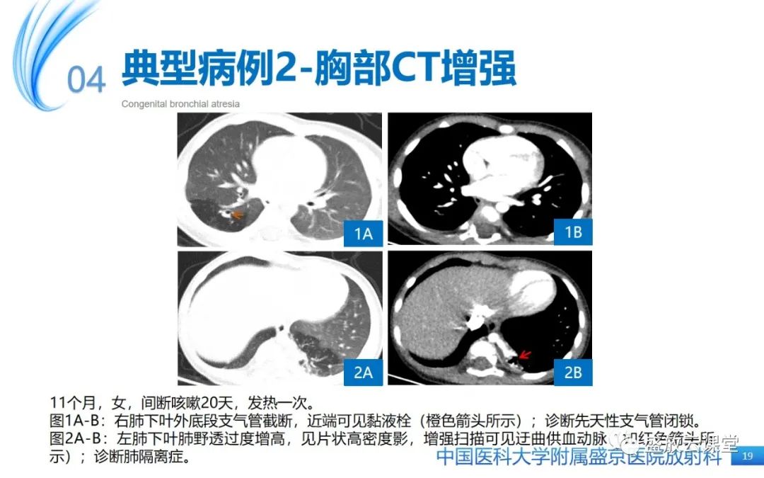 影像PPT - 【PPT】先天性支气管闭锁-18
