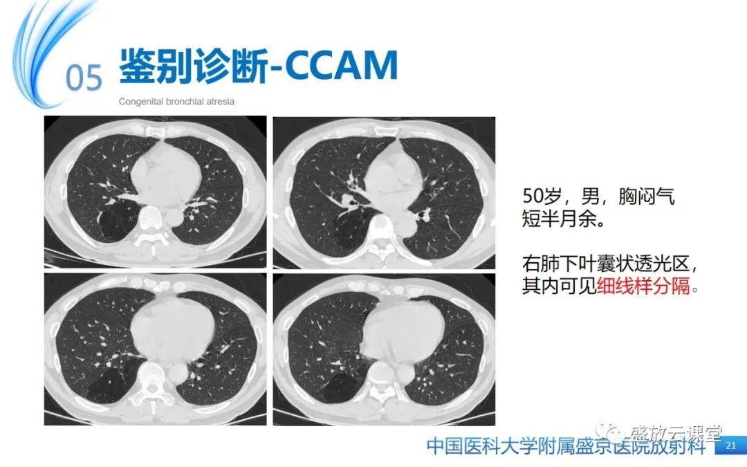 影像PPT - 【PPT】先天性支气管闭锁-20