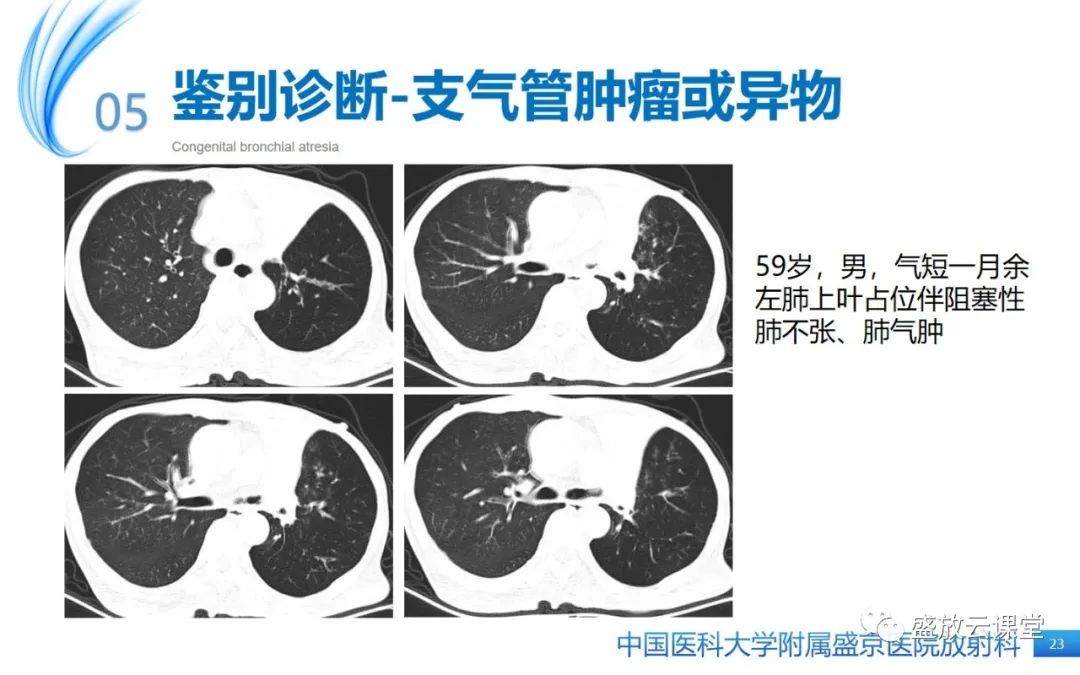 影像PPT - 【PPT】先天性支气管闭锁-22