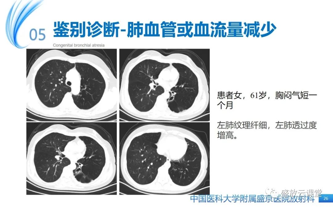 影像PPT - 【PPT】先天性支气管闭锁-25