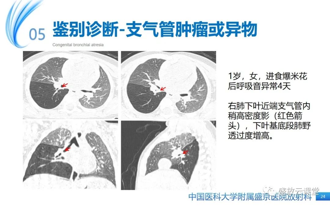 影像PPT - 【PPT】先天性支气管闭锁-23