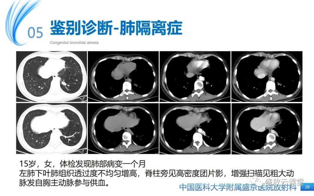 影像PPT - 【PPT】先天性支气管闭锁-27