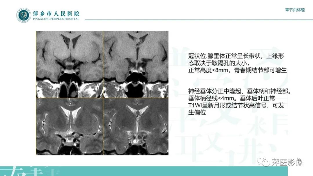 影像PPT - 【PPT】垂体常见病变-4