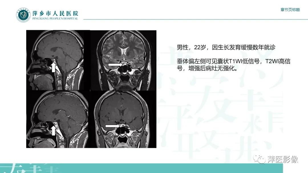 影像PPT - 【PPT】垂体常见病变-10