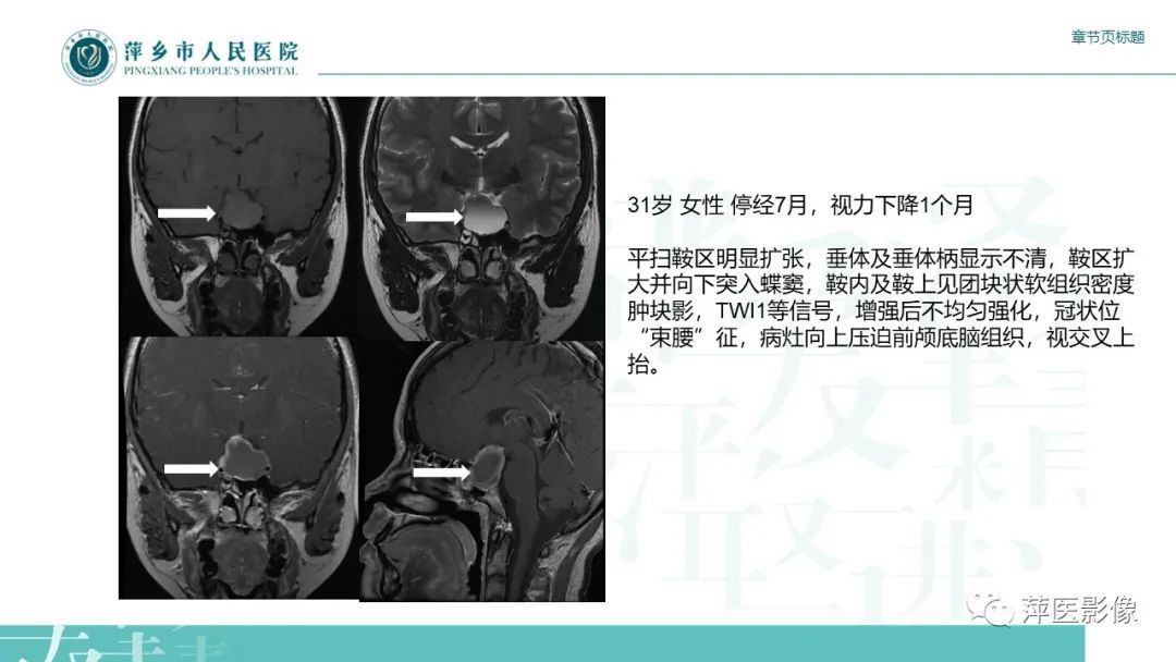 影像PPT - 【PPT】垂体常见病变-15