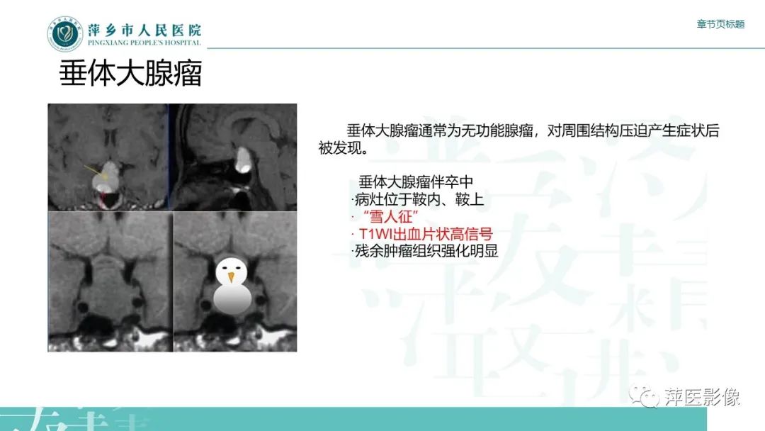 影像PPT - 【PPT】垂体常见病变-14