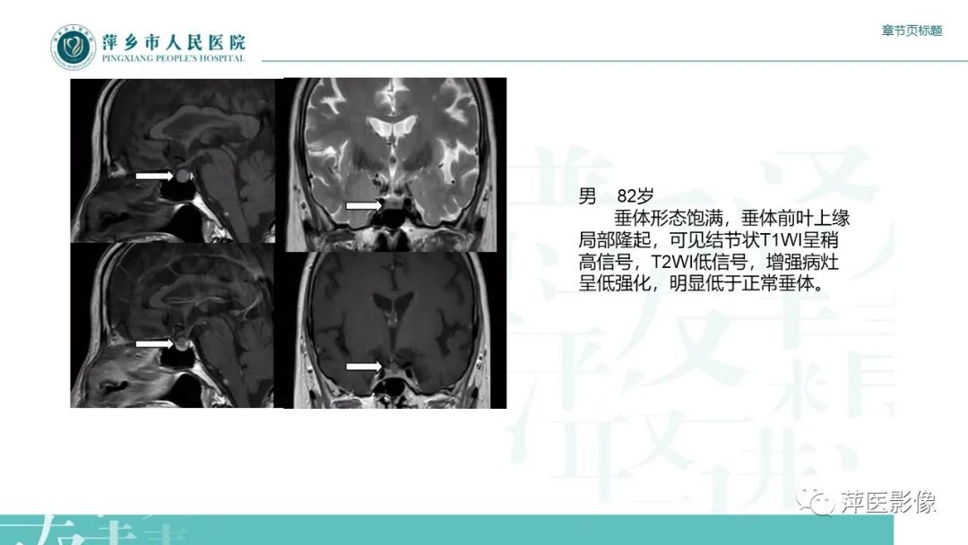影像PPT - 【PPT】垂体常见病变-13