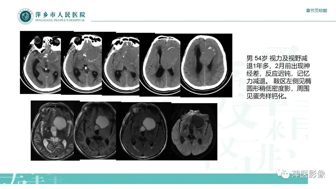 影像PPT - 【PPT】垂体常见病变-17