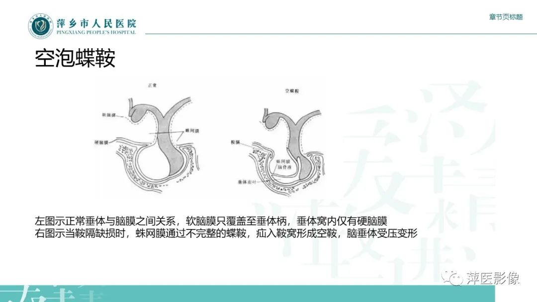 影像PPT - 【PPT】垂体常见病变-18