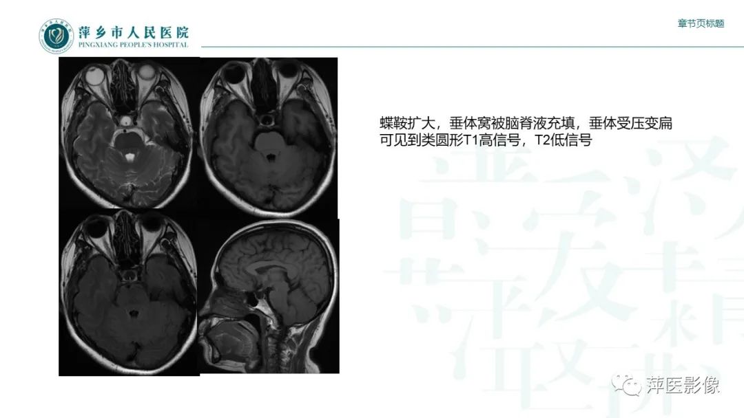 影像PPT - 【PPT】垂体常见病变-19