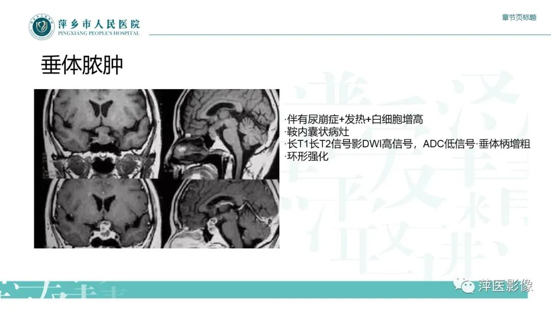 影像PPT - 【PPT】垂体常见病变-21