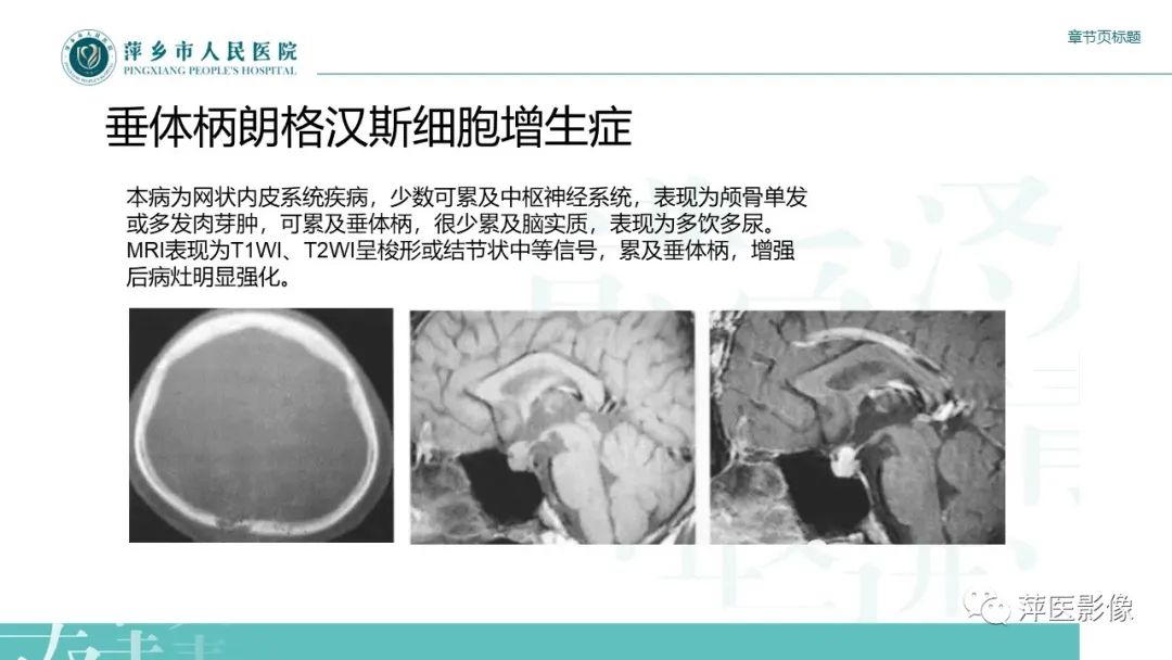 影像PPT - 【PPT】垂体常见病变-23