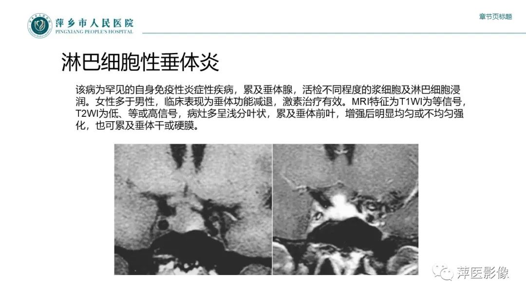 影像PPT - 【PPT】垂体常见病变-24