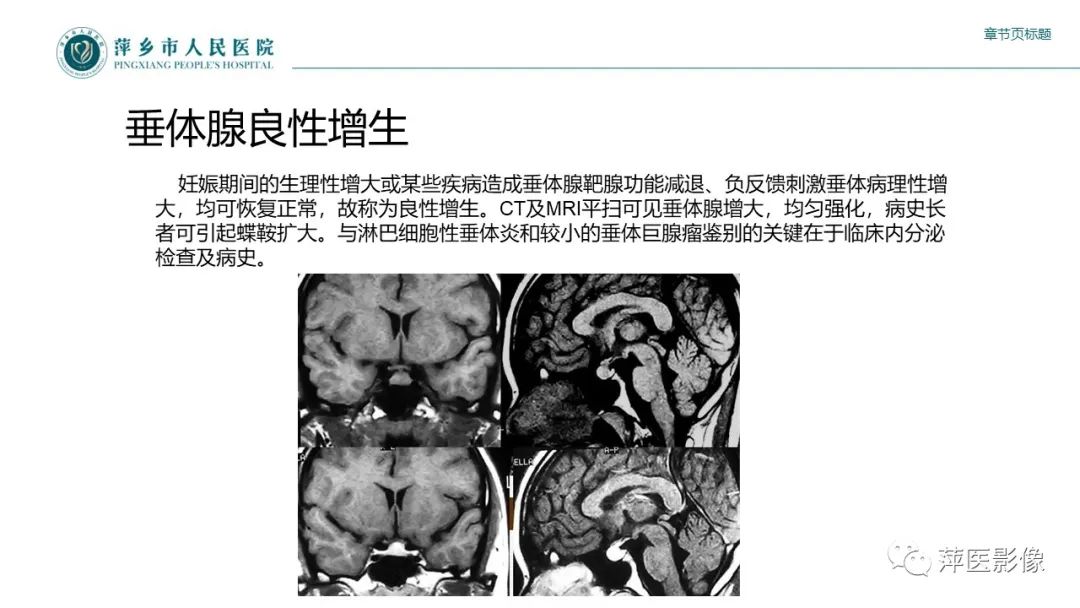 影像PPT - 【PPT】垂体常见病变-25