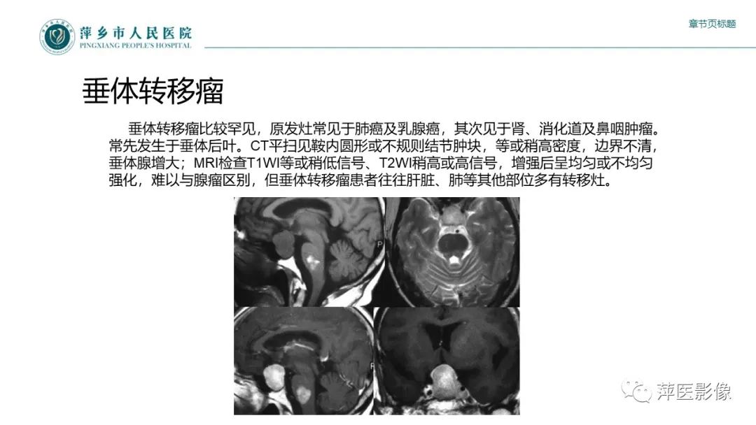 影像PPT - 【PPT】垂体常见病变-26