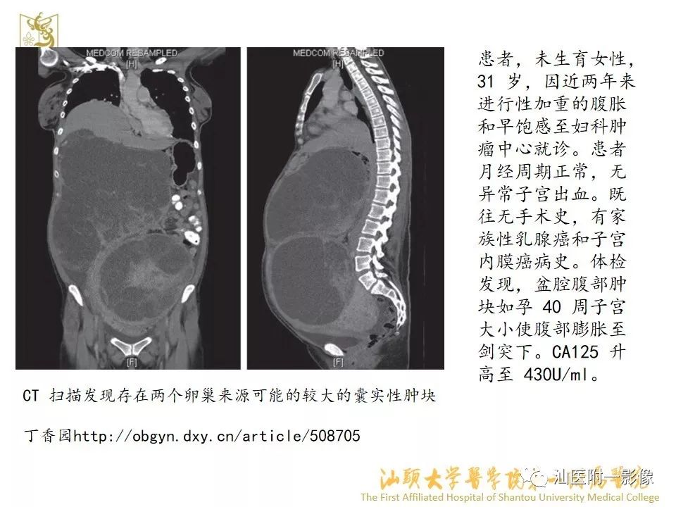 影像PPT - 【PPT】特殊类型子宫平滑肌瘤的影像诊断-4