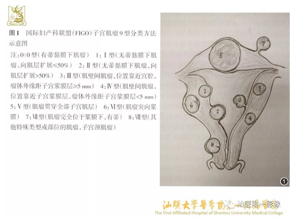 影像PPT - 【PPT】特殊类型子宫平滑肌瘤的影像诊断-3