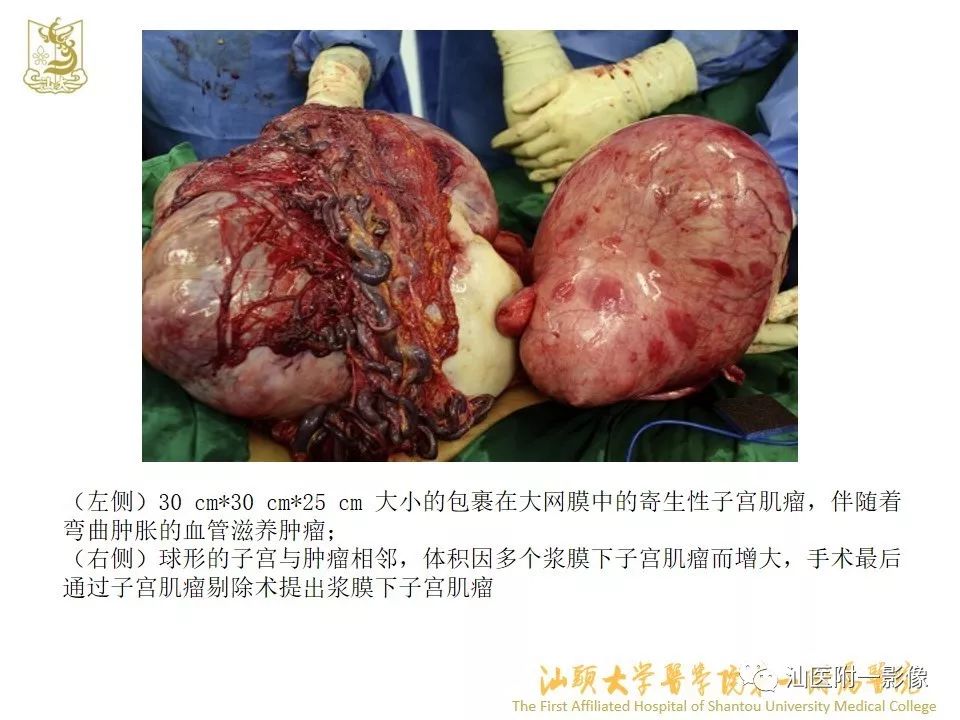 影像PPT - 【PPT】特殊类型子宫平滑肌瘤的影像诊断-6