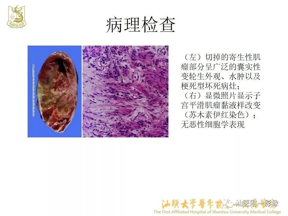 影像PPT - 【PPT】特殊类型子宫平滑肌瘤的影像诊断-7