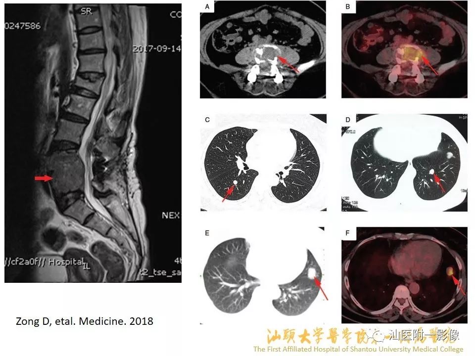 影像PPT - 【PPT】特殊类型子宫平滑肌瘤的影像诊断-15