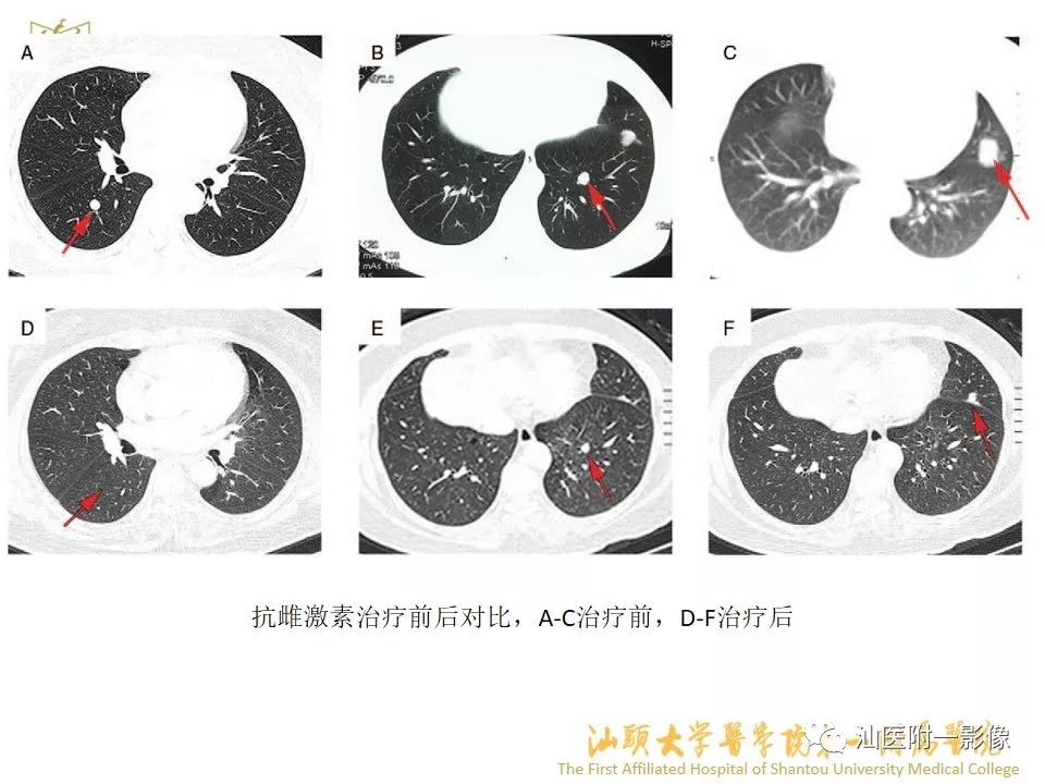 影像PPT - 【PPT】特殊类型子宫平滑肌瘤的影像诊断-16