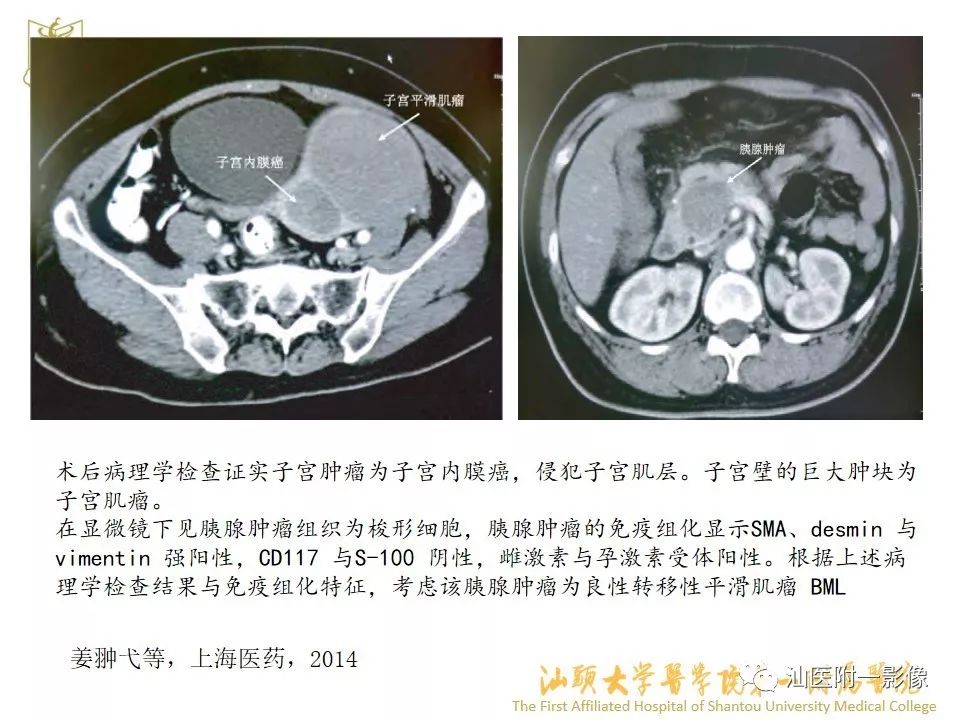 影像PPT - 【PPT】特殊类型子宫平滑肌瘤的影像诊断-17
