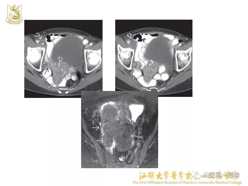 影像PPT - 【PPT】特殊类型子宫平滑肌瘤的影像诊断-28