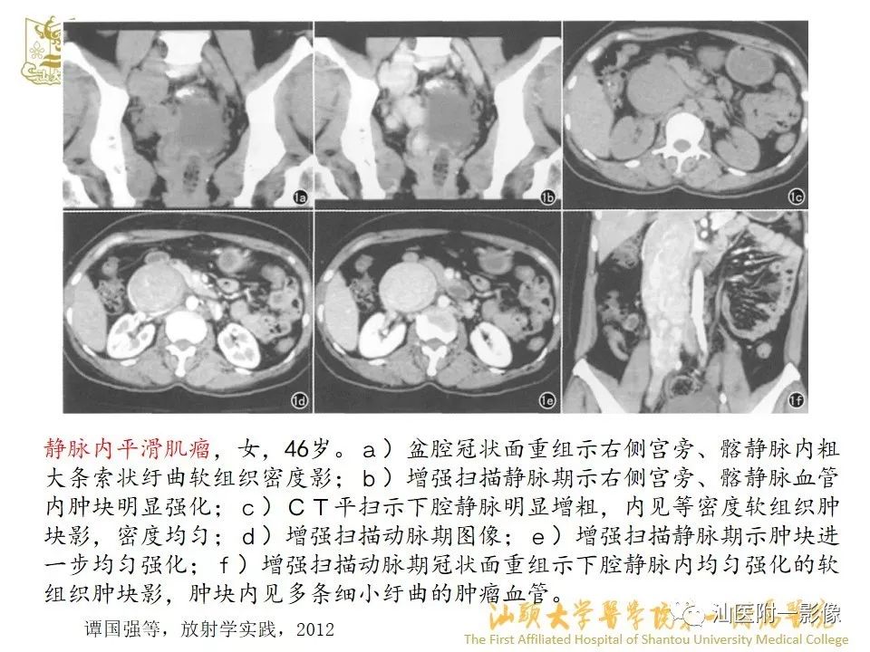 影像PPT - 【PPT】特殊类型子宫平滑肌瘤的影像诊断-29