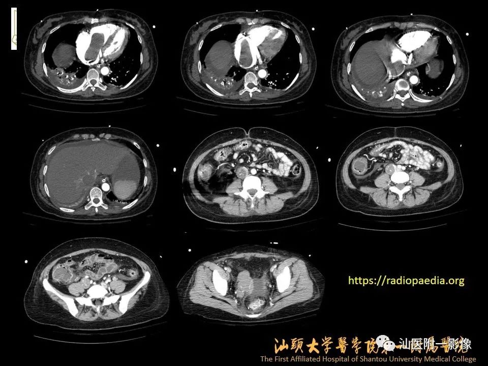 影像PPT - 【PPT】特殊类型子宫平滑肌瘤的影像诊断-30