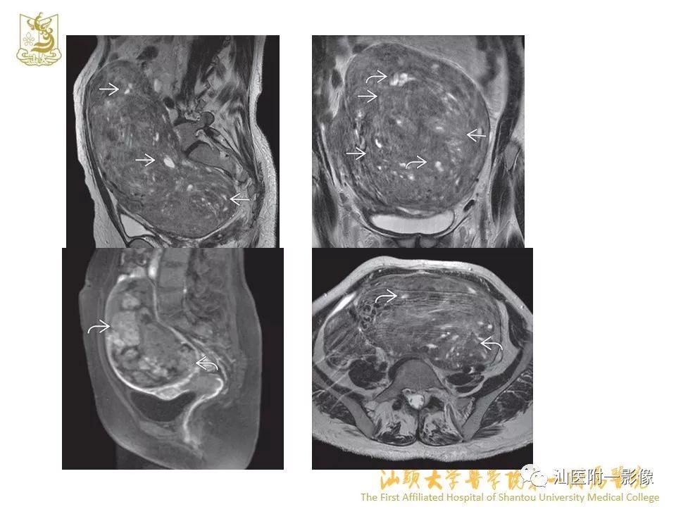 影像PPT - 【PPT】特殊类型子宫平滑肌瘤的影像诊断-34