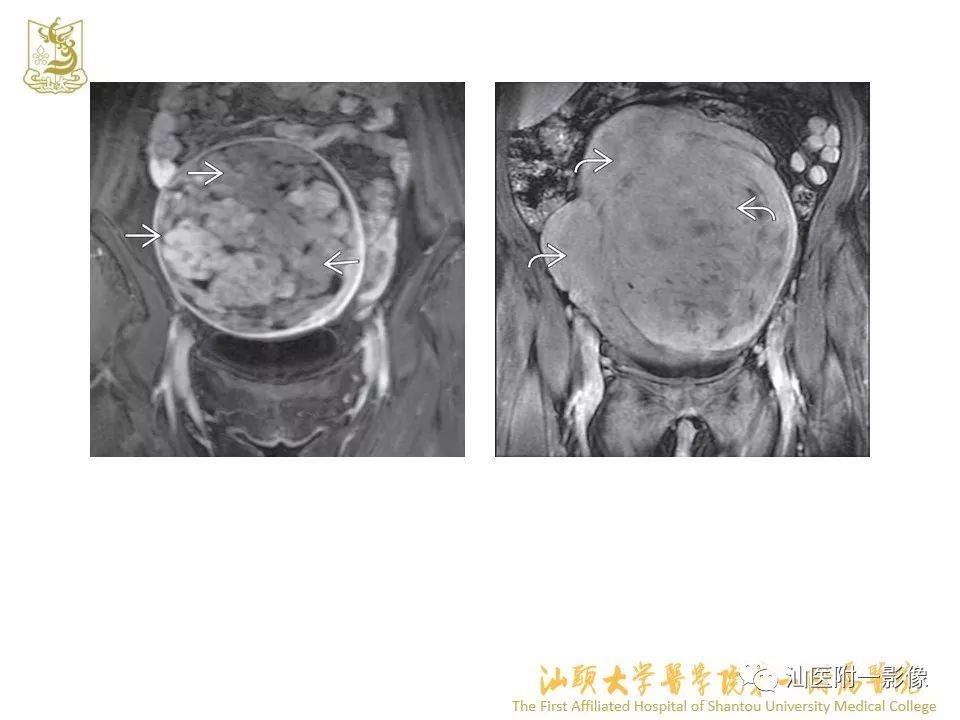 影像PPT - 【PPT】特殊类型子宫平滑肌瘤的影像诊断-36