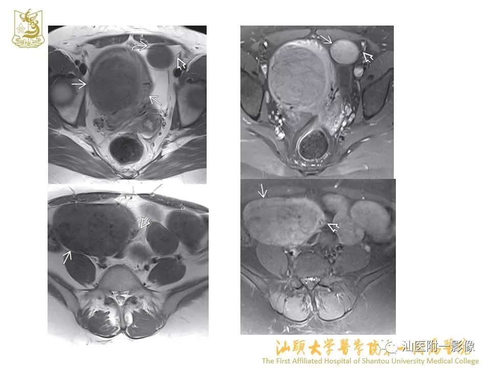 影像PPT - 【PPT】特殊类型子宫平滑肌瘤的影像诊断-40