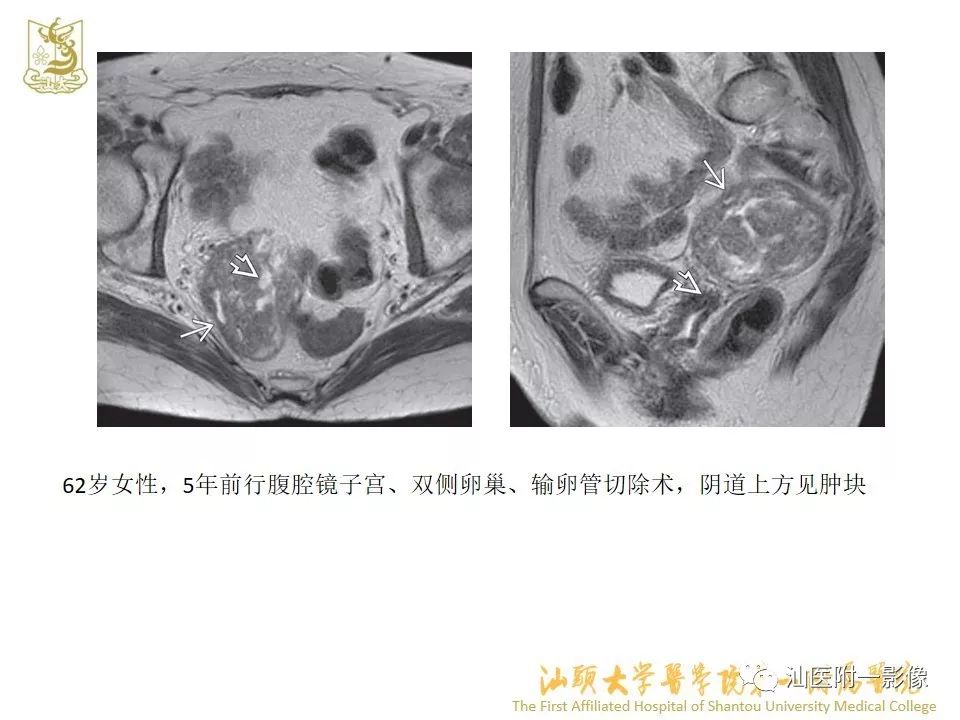 影像PPT - 【PPT】特殊类型子宫平滑肌瘤的影像诊断-41