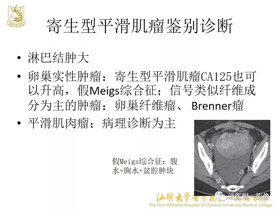 影像PPT - 【PPT】特殊类型子宫平滑肌瘤的影像诊断-42
