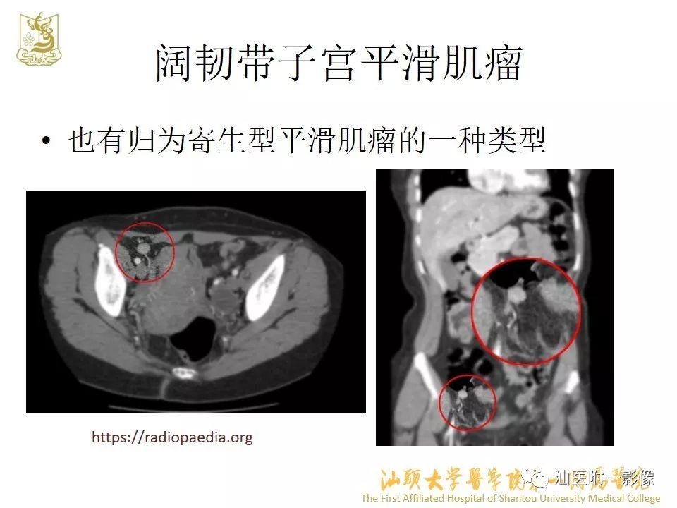 影像PPT - 【PPT】特殊类型子宫平滑肌瘤的影像诊断-43