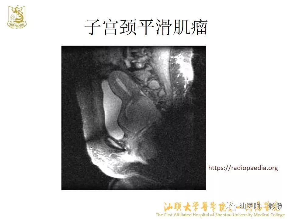 影像PPT - 【PPT】特殊类型子宫平滑肌瘤的影像诊断-44
