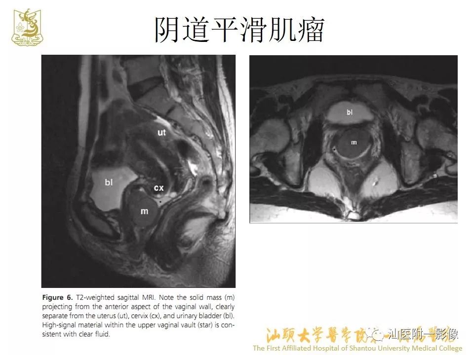 影像PPT - 【PPT】特殊类型子宫平滑肌瘤的影像诊断-45