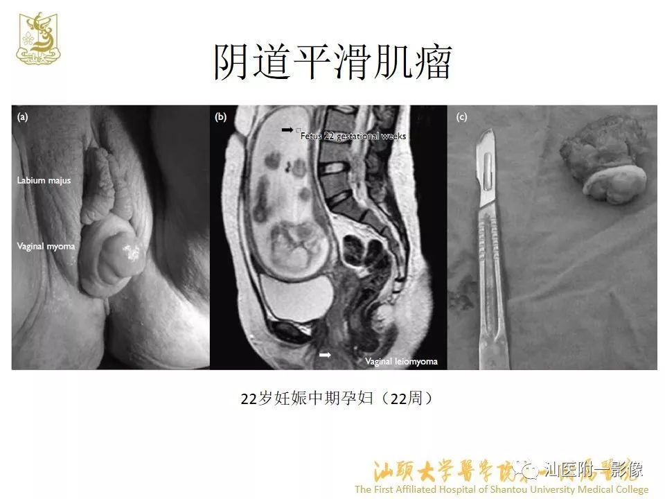 影像PPT - 【PPT】特殊类型子宫平滑肌瘤的影像诊断-46