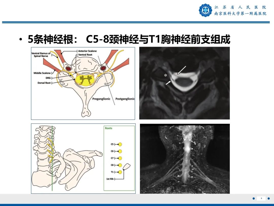 影像PPT - 【PPT】臂丛病变-10