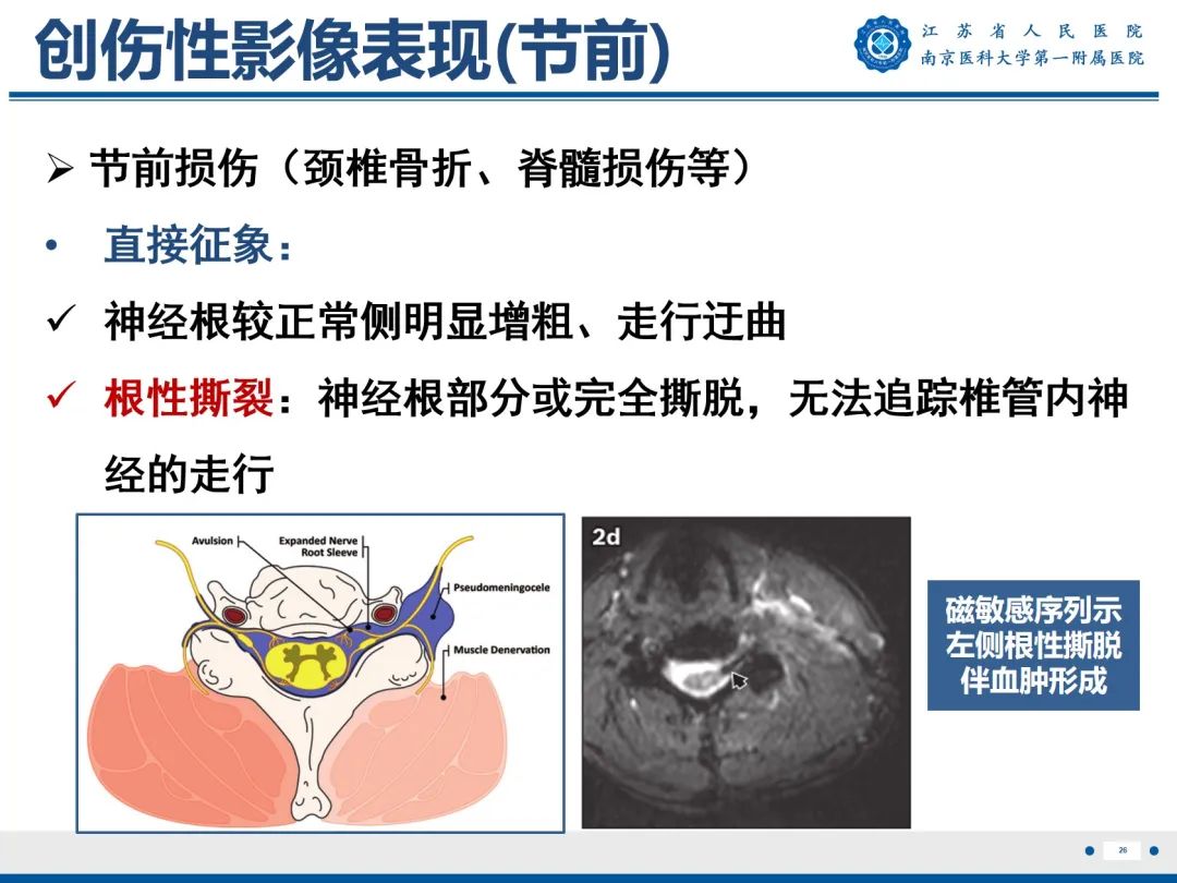 影像PPT - 【PPT】臂丛病变-27