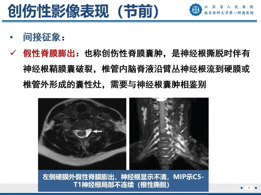 影像PPT - 【PPT】臂丛病变-28