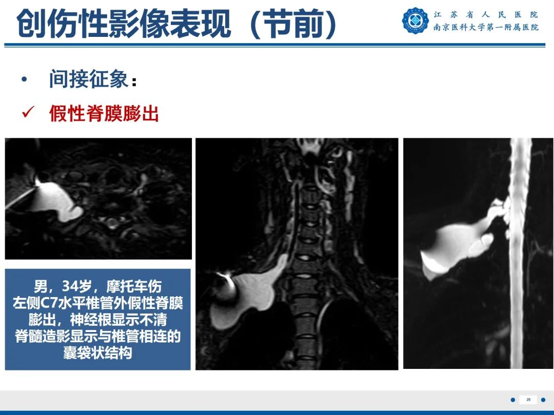 影像PPT - 【PPT】臂丛病变-29