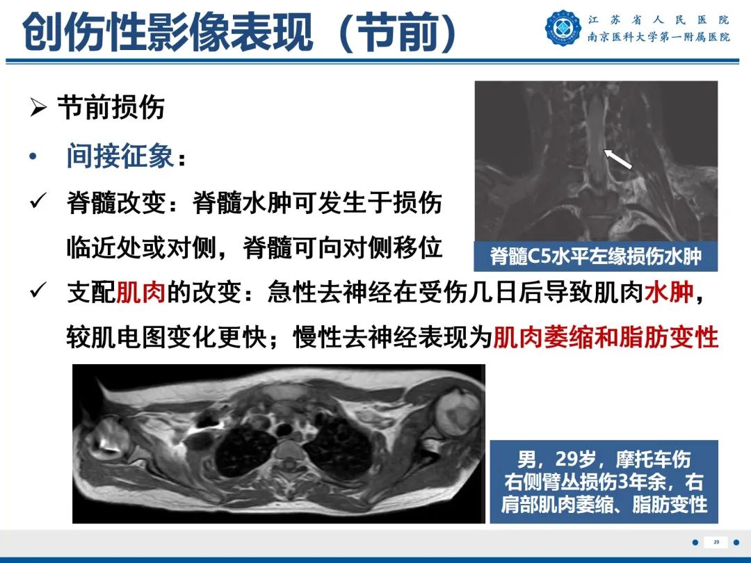 影像PPT - 【PPT】臂丛病变-30