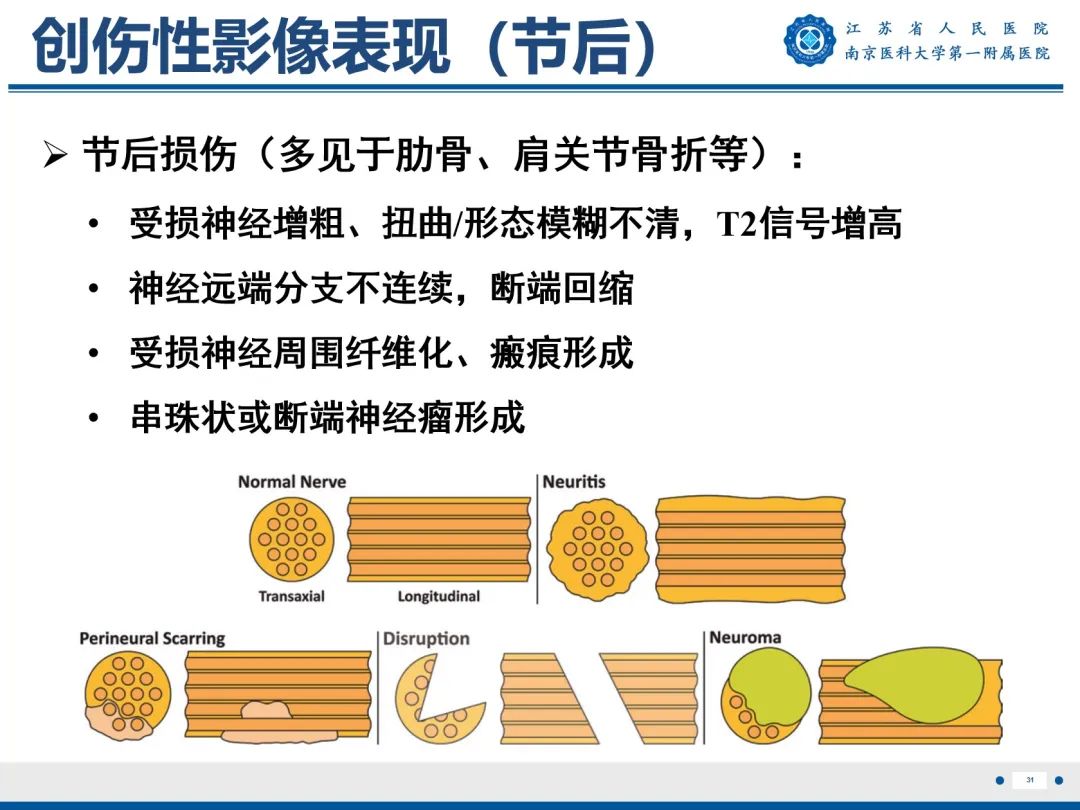 影像PPT - 【PPT】臂丛病变-32