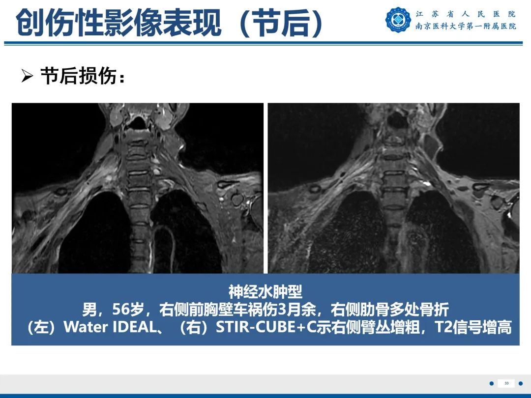 影像PPT - 【PPT】臂丛病变-34