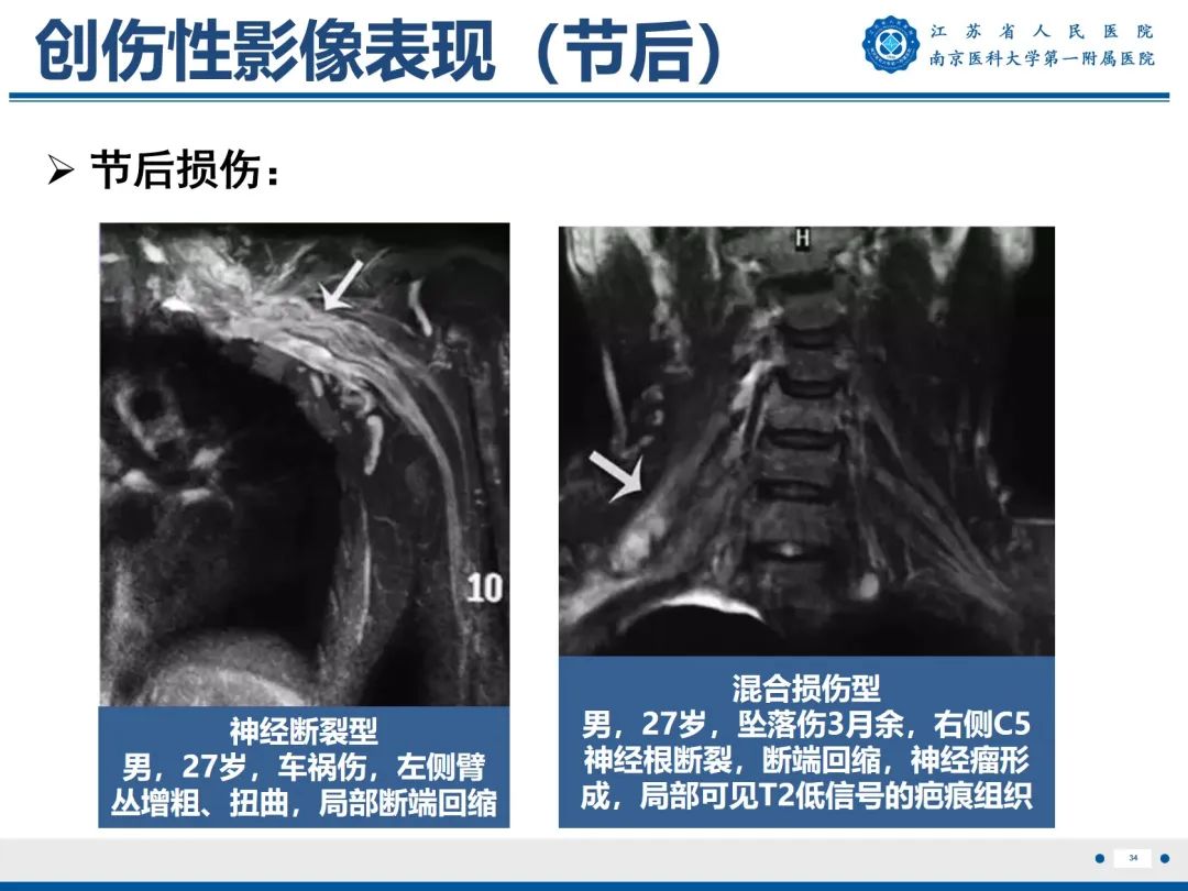 影像PPT - 【PPT】臂丛病变-35