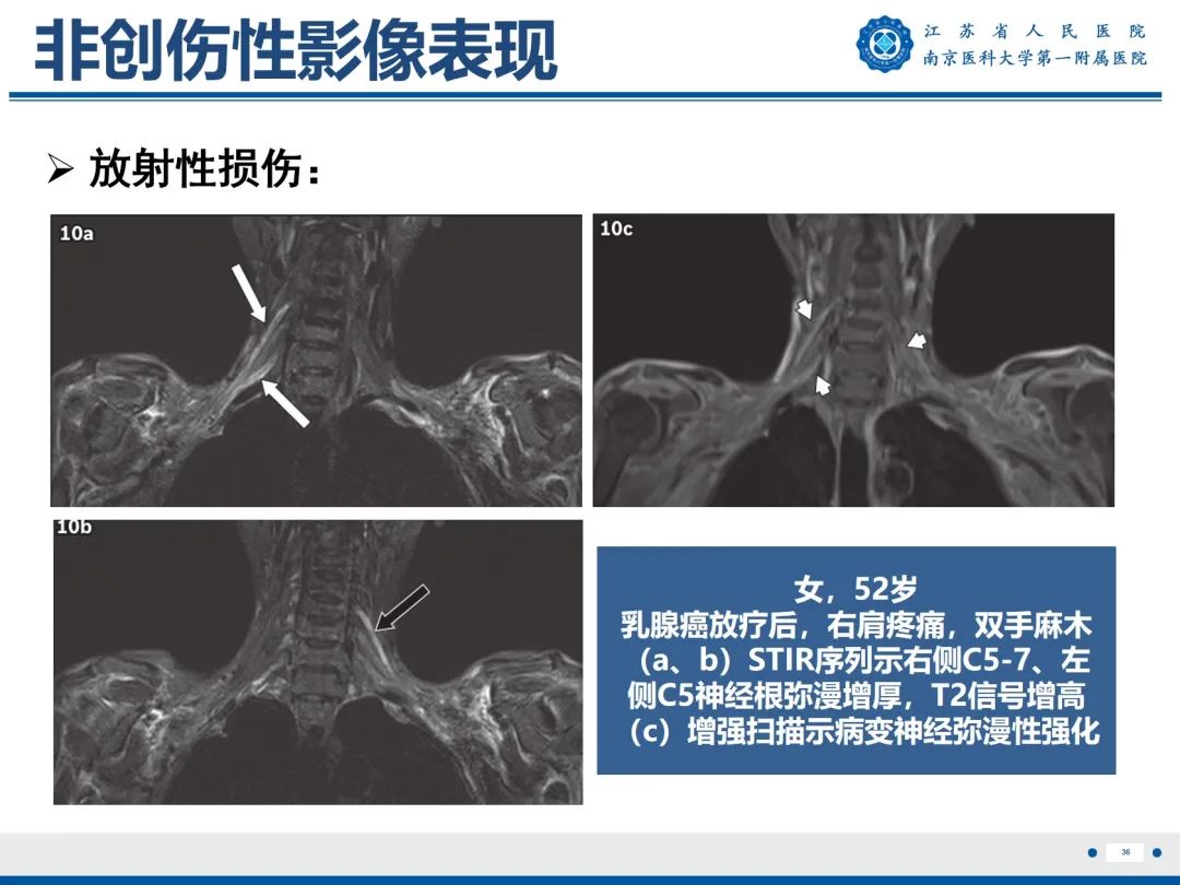 影像PPT - 【PPT】臂丛病变-37