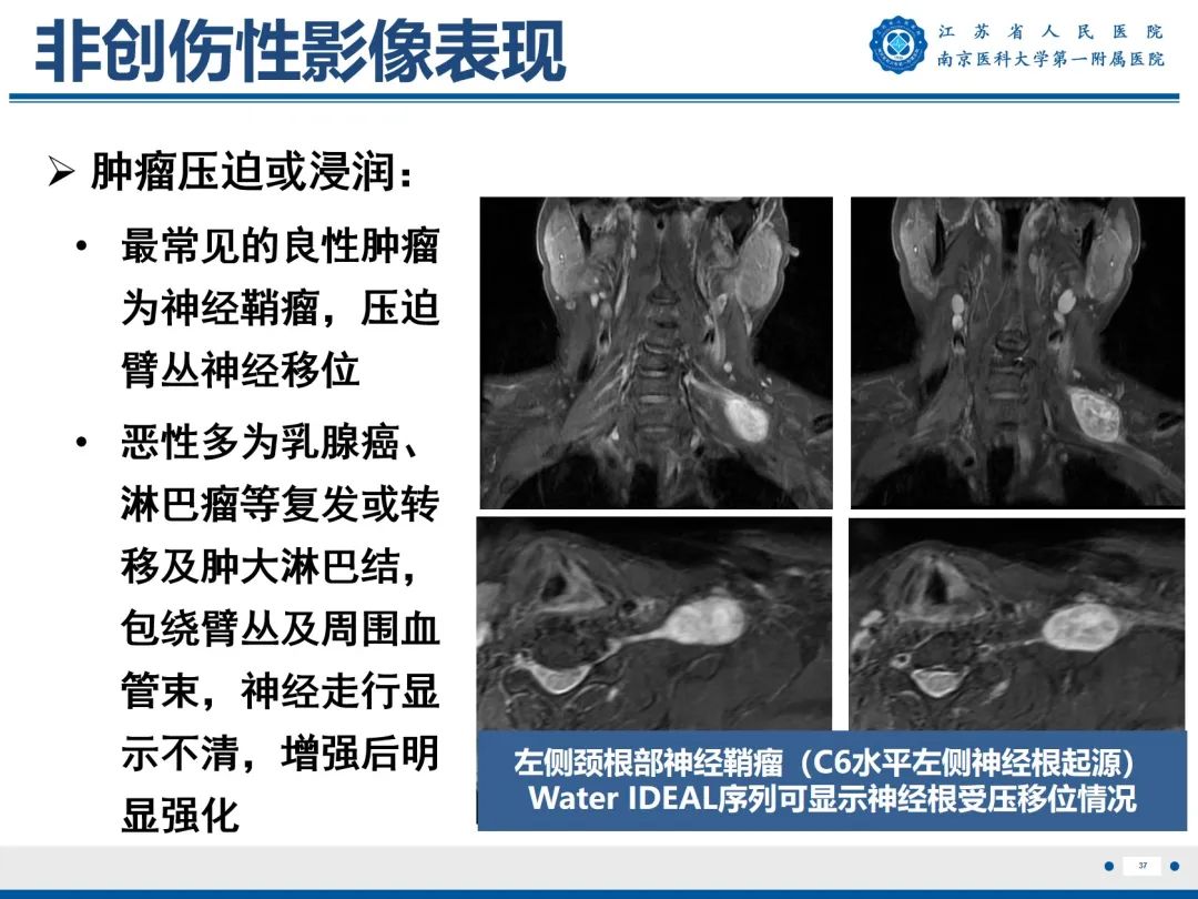 影像PPT - 【PPT】臂丛病变-38