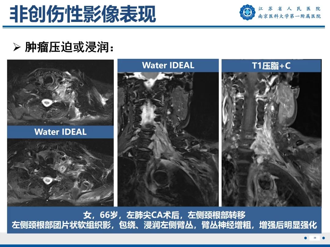 影像PPT - 【PPT】臂丛病变-39