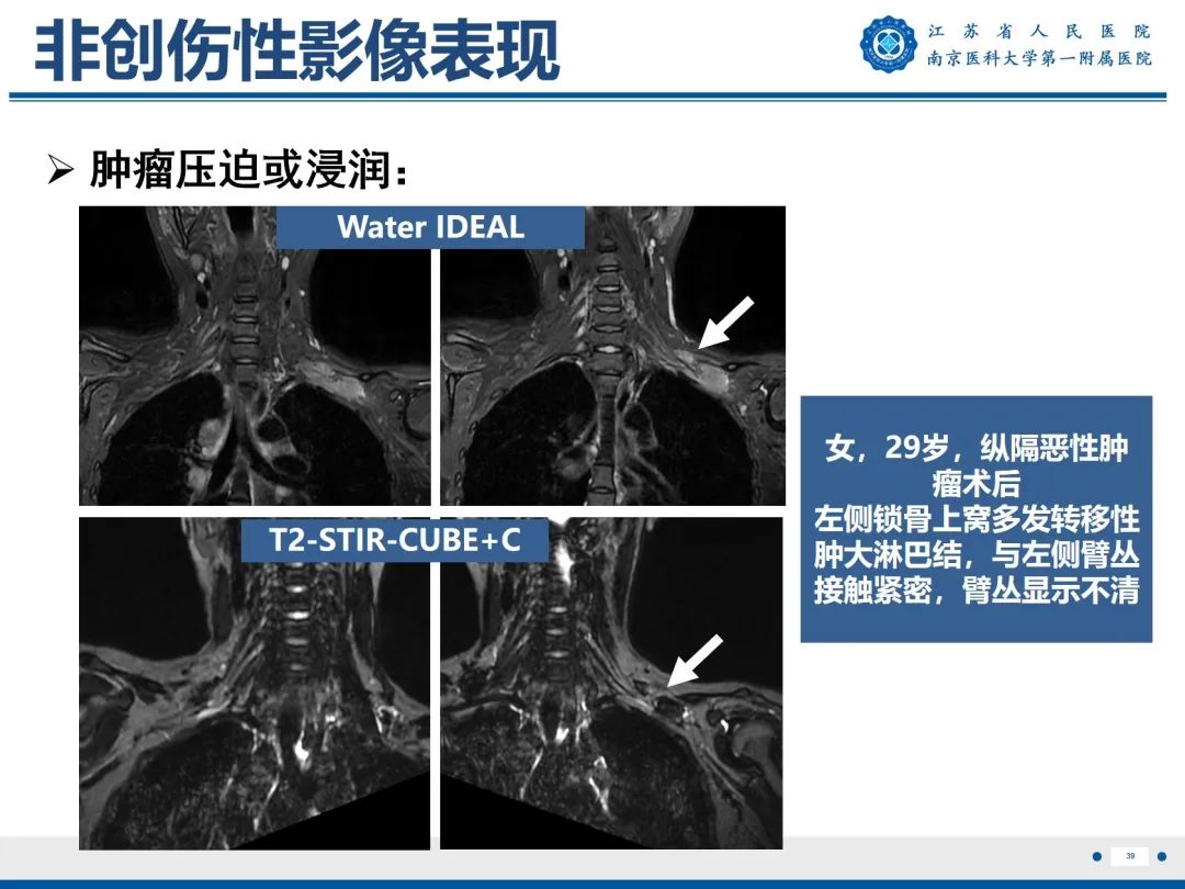 影像PPT - 【PPT】臂丛病变-40